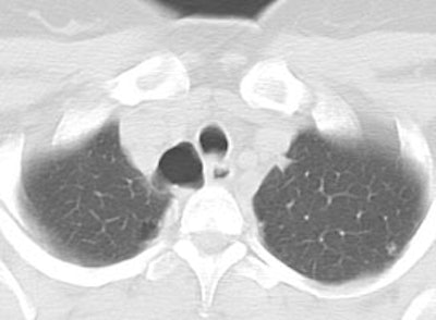 Tracheal_tic1.JPG (14692 bytes)