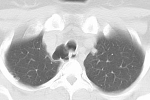 Tracheal_tic2.JPG (15636 bytes)