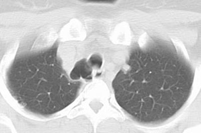 Tracheal_tic2.JPG (15636 bytes)