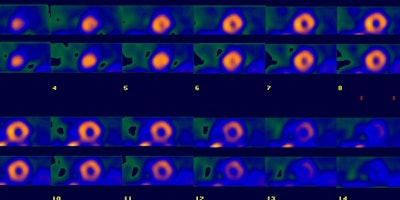 Trans Dilatation A