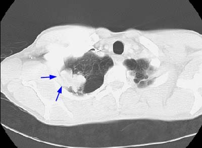 Visceral Pleural Invasion1