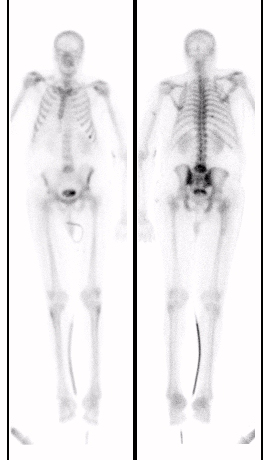 Wb Bone Scan
