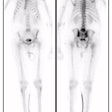 Wb Bone Scan