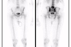Wb Bone Scan