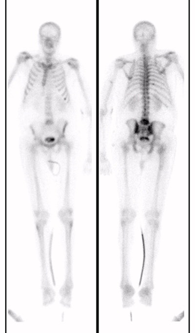 Wb Bone Scan