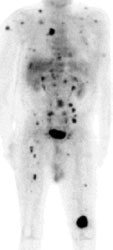 Widespread_mets.JPG (7305 bytes)