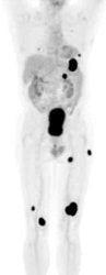 Widespread_mets_avi.JPG (7263 bytes)