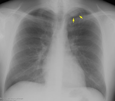 Cxr