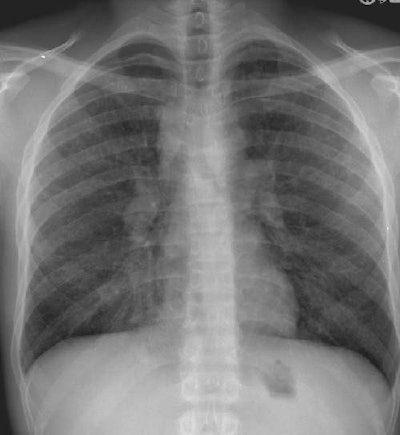 Cxr1