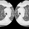 /ScottWilliamsMD2/CHEST/General/ChestCT/Images/Mosaic%20attenuation/Drug%20reaction/mosaic-gen.jpg (76558 bytes)