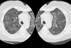 /ScottWilliamsMD2/CHEST/General/ChestCT/Images/Mosaic%20attenuation/Drug%20reaction/mosaic-gen.jpg (76558 bytes)