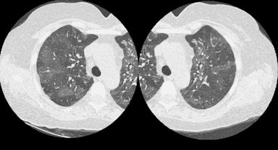 /ScottWilliamsMD2/CHEST/General/ChestCT/Images/Mosaic%20attenuation/Drug%20reaction/mosaic-gen.jpg (76558 bytes)