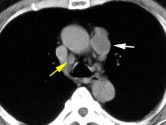 Node Ct S