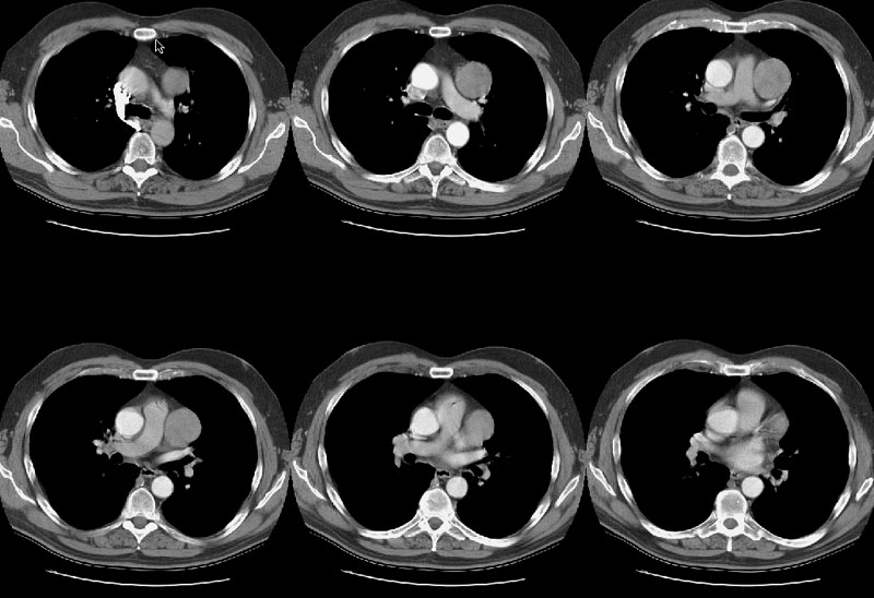 Thymoma