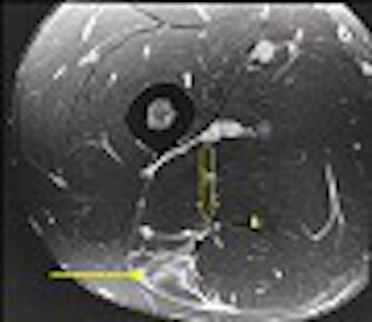Hamstring Cancer Mri The role of MRI and US in acute hamstring injuries: A preliminary ...