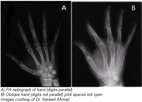 The twists and turns of hand and wrist x-ray positioning | AuntMinnie