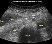 Ultrasound of the pancreas: what normal looks like | AuntMinnie