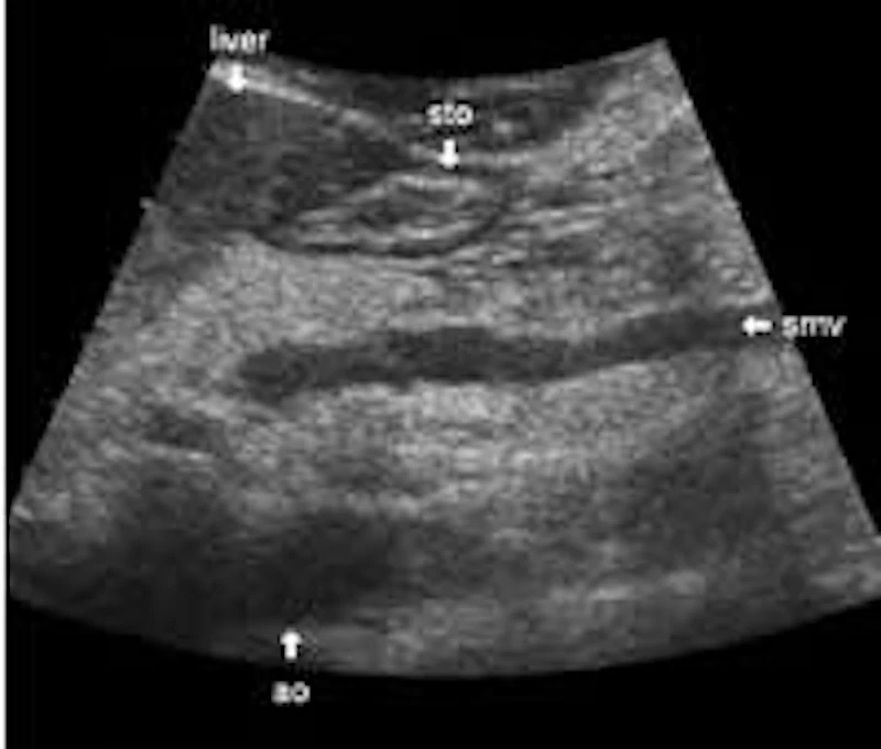 Ultrasound of the pancreas: what normal looks like | AuntMinnie