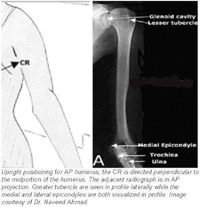 Boning up on humerus, clavicle, and AC joint positioning