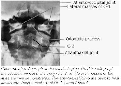 atlanto occipital joint xray