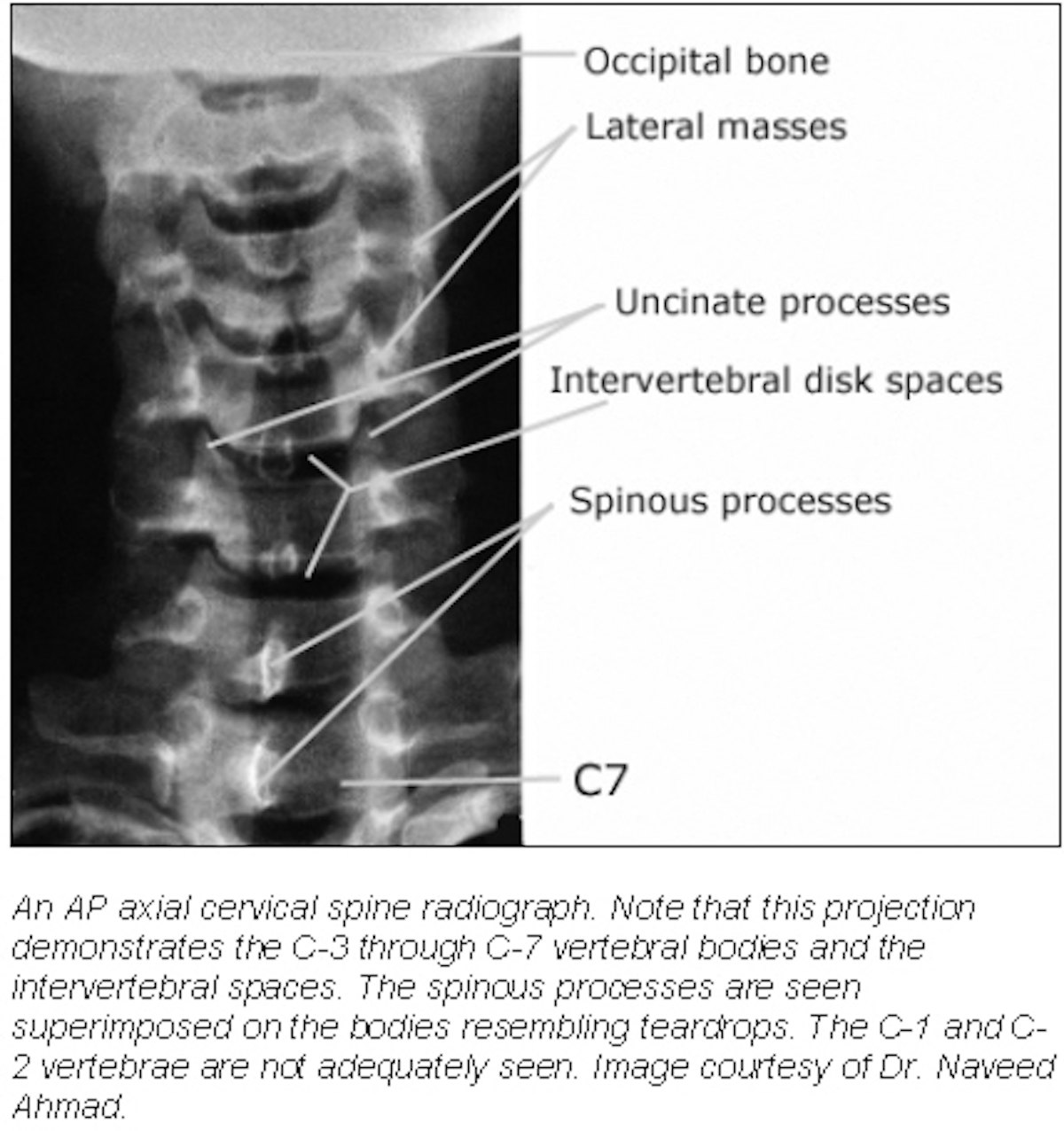 A drawing of a lateral spinal radiograph describing the rib-index