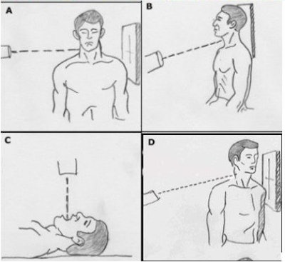 (A) For the erect lateral view of the cervical spine, the patient is standing or sitting, with head straight in neutral position. The CR is directed horizontal to the center of C-4 vertebra (at the level of the chin). (B) For the AP view of the cervical spine, the patient is either erect or recumbent. The beam is directed toward the C-4 vertebra (at the Adam's apple) at an angle of 15°-20° cephalad. (C) For the open-mouth view, the patient is positioned in the same manner as for the supine AP projection; the head is straight, in the neutral position. With the patient's mouth open as wide as possible, the CR is directed perpendicular to the midpoint of the open mouth. (D) For the oblique view of the cervical spine, the patient may be erect or recumbent. The patient is rotated 45° to the left, to demonstrate the right-side neural foramina. The CR is directed to the C-4 vertebra with 15°-20° cephalad angulation. Image courtesy of Dr. Naveed Ahmad.