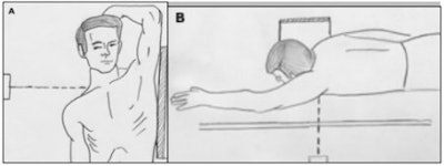 (A) For a swimmer’s view projection, the arm adjacent to the vertical grid is elevated and flexed, resting the forearm on the head for support, while the other arm is depressed and moved slightly anterior to place the vertebral head anterior to the vertebrae. The CR is centered to T1 and directed perpendicular to the shoulder. (B) A swimmer’s view projection can also be taken with the patient placed prone on the table with the left hand abducted 180° and the right hand to the side, as if swimming. The cassette is placed against the right side of the neck. Image courtesy of Dr. Naveed Ahmad.