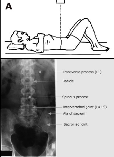 Lumbar spine, Radiology Reference Article