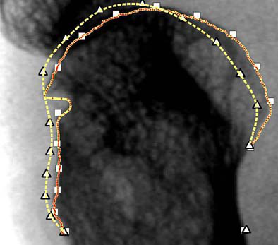X-ray CAD finds bone defects in rheumatoid arthritis | AuntMinnie