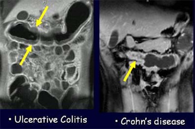Ulcerative colitis, Radiology Reference Article