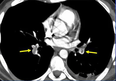 Ctpe CT for PE: Best test gets better | AuntMinnie