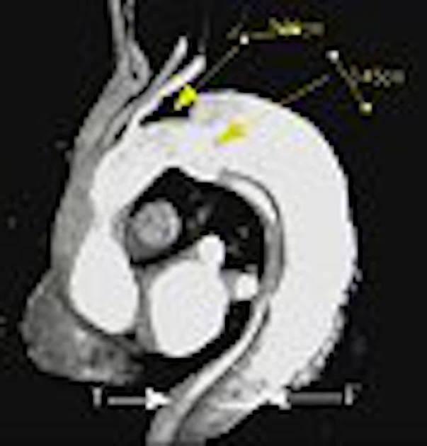 Dynamic Mra Dissection 3D contrast MRA may be optimal for evaluating aortic dissection ...