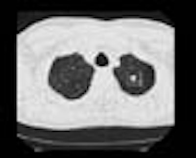 AuntMinnieTV: I-ELCAP results predict lung cancer risk