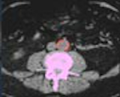 AuntMinnieTV: Virtual colonoscopy learns a new trick