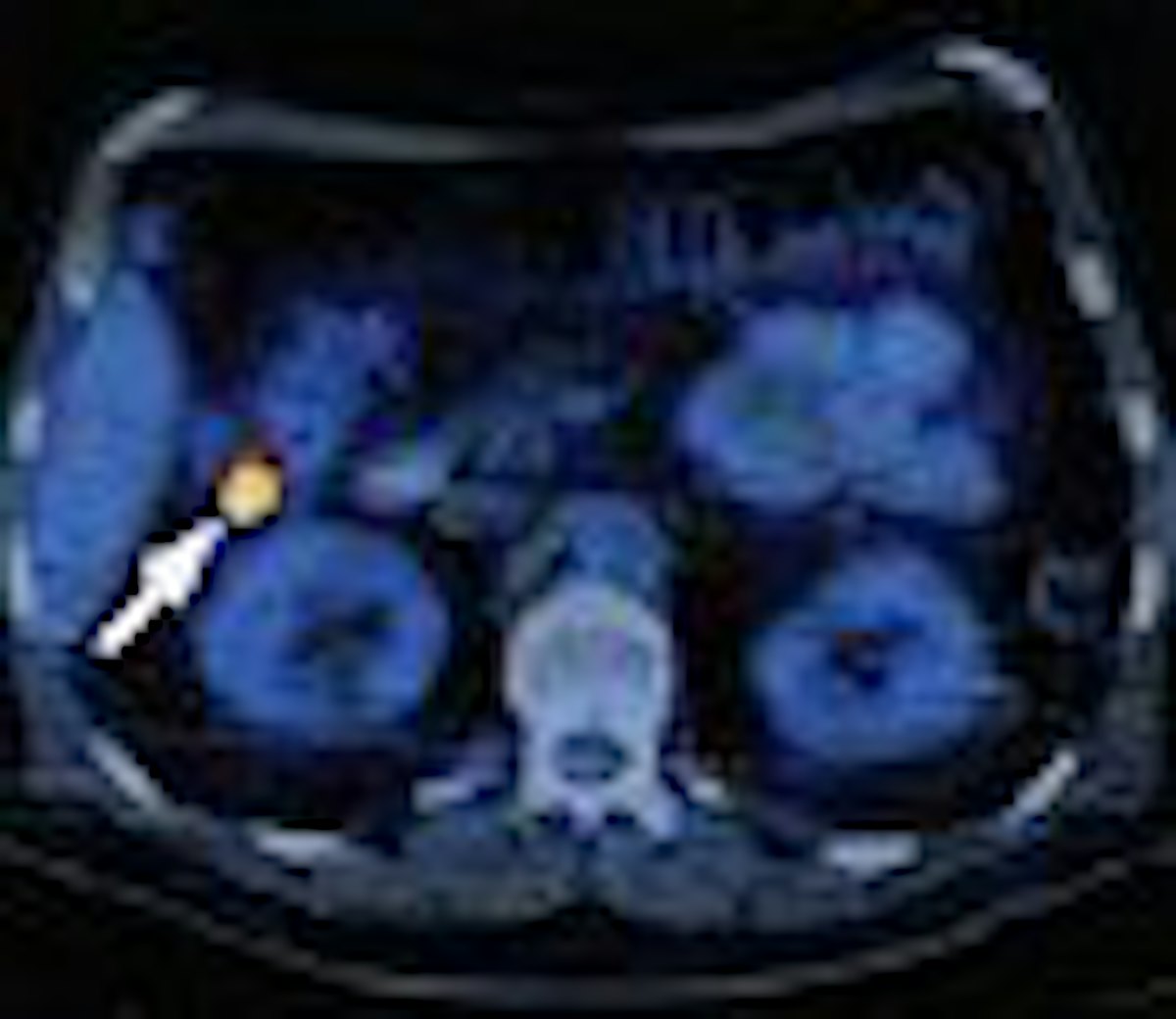 Incidental focal findings on FDG PET/CT need follow-up endoscopy ...