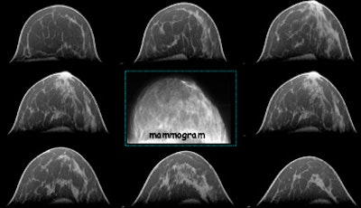 Breast CT developers aim to 'revolutionize' mammography
