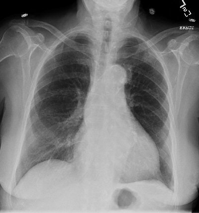 Dual-energy digital x-ray still looking for acceptance | AuntMinnie