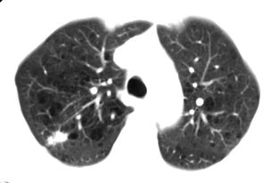 Nsclc Neo Ct