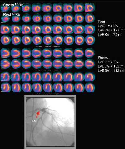 Rubidium PET/CT shows potential for coronary artery disease diagnosis ...