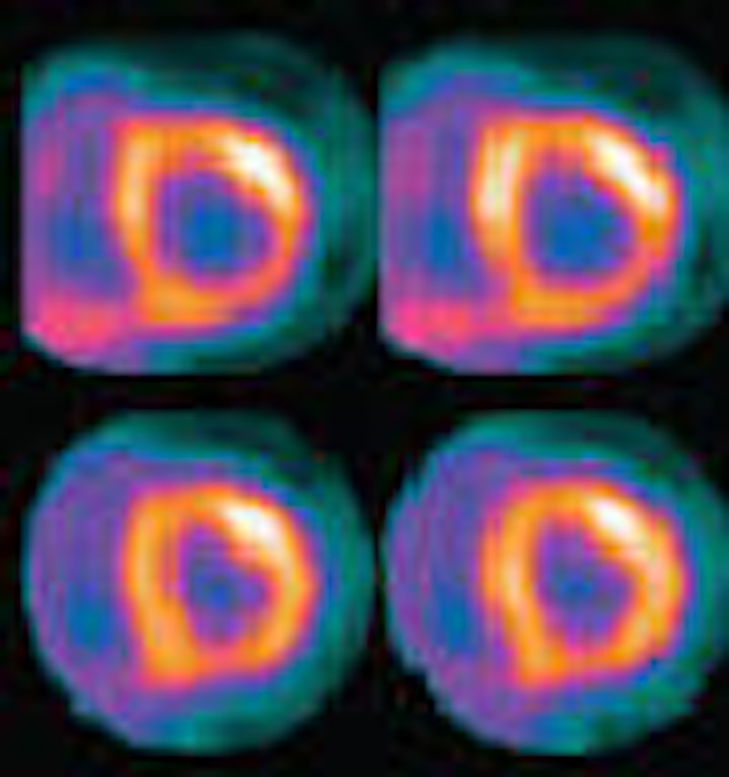 Rubidium PET/CT shows potential for coronary artery disease diagnosis ...