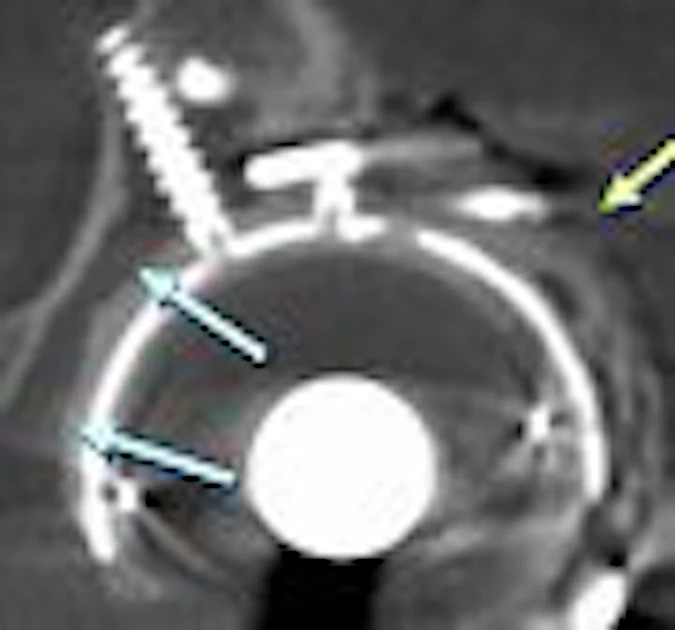 Metallic Disc Ct MRI, CT prove their metal for imaging orthopedic hardware | AuntMinnie