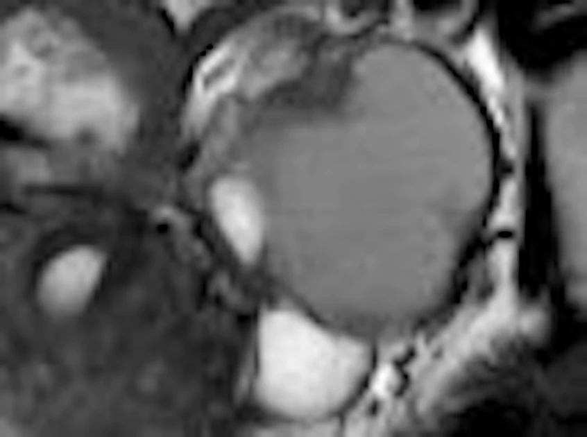 3-tesla MRI sheds light on shading sign in endometriosis | AuntMinnie