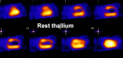 Scar Thallium