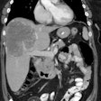 Coronal Ct