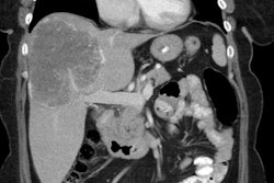 Coronal Ct