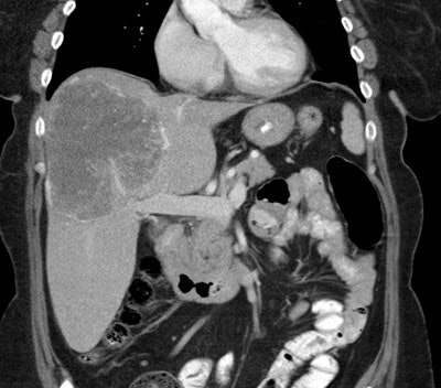 Coronal Ct