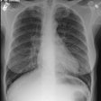 Eg1 Cxr Sm