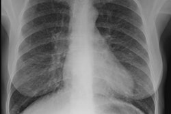 Eg1 Cxr Sm