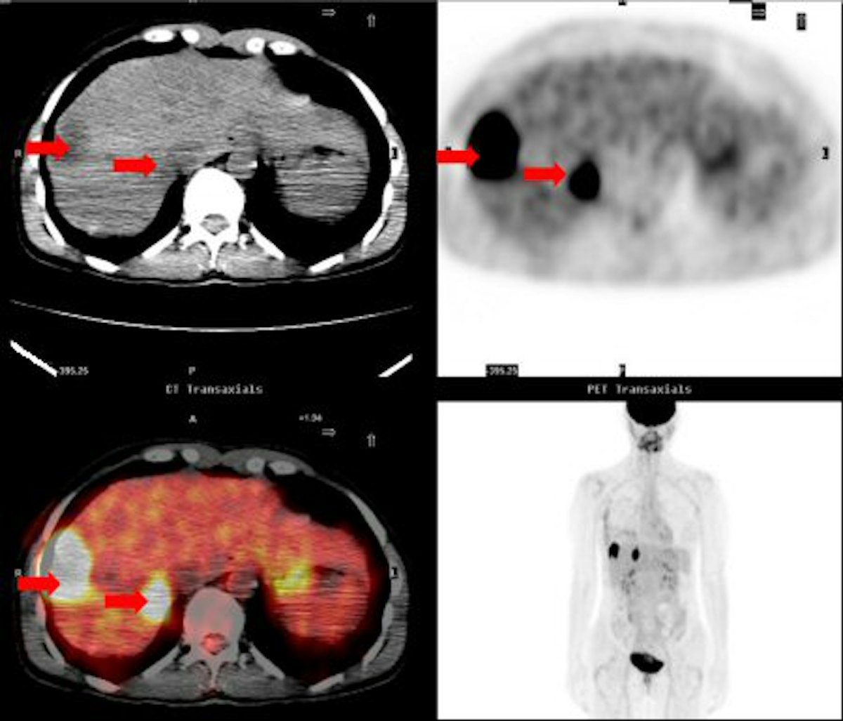MRI and FDG-PET/CT recommended for advanced breast cancer | AuntMinnie