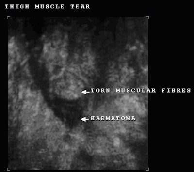Fig. 6: 3D reconstruction (enlarged image) confirming the continued presence of the muscle tear and hematoma.